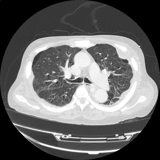 ct_chest_anemia_12